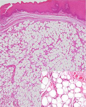 Histologic appearance (hematoxylin-eosin stain, original magnification, ×200; inset ×400).