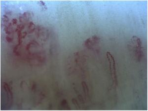 Dermatomyositis. Megacapillaries, bushy capillaries, and capillary loss with disorganization of the capillary array.
