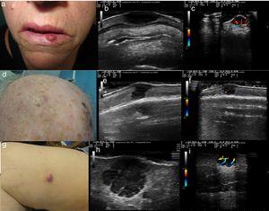A (case 1), Firm, indurated, erythematous lesion with a diameter of 1cm on the left side of the lower lip; B, B-mode image showing a homogeneous hypoechoic dermal lesion with well-defined margins; C, Color Doppler image showing predominant hypervascularity in the basal area; D (case 2), Subcutaneous nodule with a diameter of 8mm located in the right parietal region and covered by pink skin; E, B-mode image showing a hypoechoic dermal/epidermal lesion; F, Color Doppler image showing a weak signal around the lesion; G (case 3), Pink nodule with a diameter of 18mm on the internal aspect of the right thigh; H, B-mode image showing a hypoechoic polylobular dermal/hypodermal lesion with well-defined margins, posterior acoustic reinforcement, and predominant intralesional vascularity in the septae.