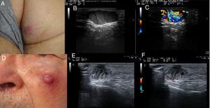 A (case 4), Subcutaneous lesion with a diameter of 20mm, an elastic consistency, and a violaceous surface on the right buttock; B, B-mode image showing a hypoechoic hypodermal lesion with heterogeneous content and hypoechoic plume-of-smoke lines running perpendicular to the epidermis, well-defined margins, and posterior acoustic reinforcement; C, Color Doppler image showing intralesional vascularity; D (case 5), Erythematous nodule over a subcutaneous lesion with a diameter of a 22mm on the left cheek; E, B-mode image showing a hypoechoic dermal lesion with heterogeneous content and hypoechoic plume-of-smoke lines running perpendicular to the epidermis; F, Color Doppler image showing predominant intralesional vascularity in the basal area.