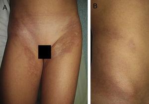 Hyperpigmented plaques with pearly areas that are indurated on palpation on the anterior-medial aspect of both thighs (A) and the right flank (B).