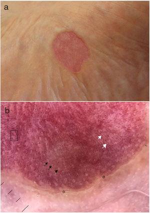 Case 1. A,Clinical image. B,Dermatoscopic image showing the stepped scaly border (asterisk), regular white spots (white arrows) on an erythematous background with punctate vessels, some of which are distributed around the white spots (black square).