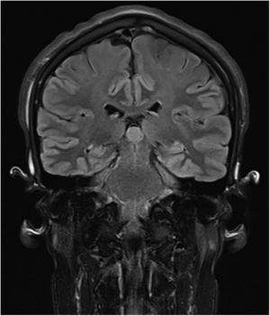 Cranial magnetic resonance imaging showing slight undulation of the extracranial soft tissue.
