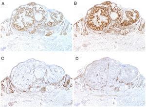 Immunohistochemical study of mismatch repair markers in an adenoma sebaceum associated with Muir-Torre syndrome, demonstrating preservation of PMS2 expression (A, ×20) and MLH1 expression (B, ×20) with loss of MSH2 expression (C, ×20) and MSH6 expression (D, ×20).