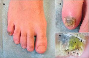Nail of the fifth toe of the right foot. A, Yellow-green discoloration of the nail plate. B, Subungual hyperkeratosis and areas of yellow, green, and black discoloration. C, Dermoscopic image showing subungual hyperkeratosis (&), an irregular distal border, brown areas with a hemorrhagic appearance (⏶), and discoloration of the nail plate with homogeneous areas of green ($) and blackish-blue (*) and longitudinally distributed areas of yellowish discoloration (→).