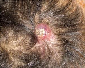 Erythematous nodule with a superficial crust on the scalp.