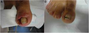 A, Patient with severe ingrown toenail, with hypertrophy of the nail fold and reactive granuloma. B, Result 3 months after 3 injections of triamcinolone.