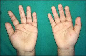 multiple skin-coloured and pink wart-like papules located on both palms.