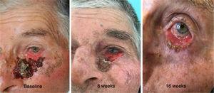 Clinical regression of left lower eyelid basal cell carcinoma during vismodegib therapy.