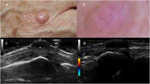 A, Skin-colored nodule located on the back of the hand at the metacarpophalangeal joint. B, Dermoscopic image of the lesion shown in A, showing a skin-colored background and nonspecific crystalline structures, as well as poorly focused irregular vascular structures. C, Ultrasound image of the lesion shown in A, showing a well-defined hypoechoic nodule located deep in the dermis. D, Ultrasound image of the lesion showing no power Doppler activity.