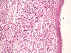 Langerhans cells with an eosinophilic cytoplasm, grooved or lobular nucleus, histiocytes with abundant pale cytoplasm and lymphocytes in the dermis.
