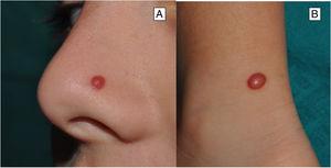 Clinical features of classic Spitz nevus. A and B, Reddish, well-defined, dome-shaped tumor, located typically on the facial region or lower limbs.