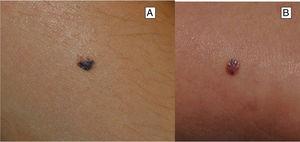 Clinical features of atypical Spitz nevus. A and B, Variegated and asymmetric melanocytic lesion.