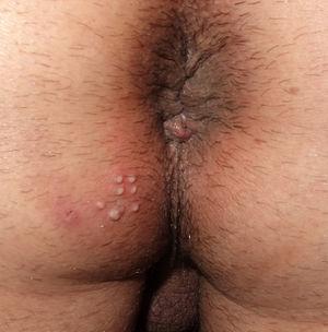 Predominantly vesiculopustular lesions.