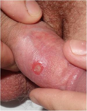 Clinical image of syphilitic chancre on the dorsum of the penis.