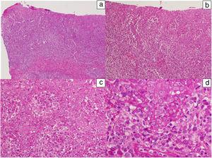 Histological images of a lesion with moderate irregular epidermal hyperplasia with pale keratinocytes and discrete spongiosis. There is a dense band of lymphoplasmacytic inflammatory infiltrate with involvement of the dermal-epidermal junction. Hematoxylin-eosin: a) ×10, b) ×20, c) ×40, and d) ×100.