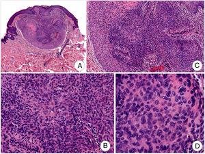 Superficial nodular tumor, circumscribed (A), consisting of fusiform and epithelioid cells with oval or rounded nuclei with no significant atypia (B, C) and poorly demarcated (D) (hematoxylin–eosin: A, ×40; B, ×100; C, ×200; D, ×400).