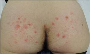 Erythematous papular lesions on the buttocks with signs of excoriation.