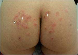 Worsening of the lesions on the buttocks with the appearance of raised serpiginous tracks (arrows).