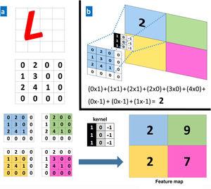 A, Example of a convolution operation. A computer sees an image (L) as a 4×4 matrix of numbers. Each value of the input image is multiplied by a filter or kernel. Consequently, a new, reduced representation is obtained (a 2×2 feature map). B, Example of a specific operation for the values in the blue box.