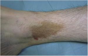 Lichen aureus. Placa solitaria compuesta por pequeñas máculas amarillo-anaranjadas coalescentes en la pierna.