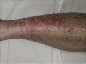Majocchi doença. Lesões vermelhas-violáceas anulares na perna.