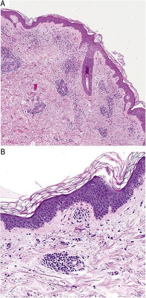 Características histopatológicas da doença de Schamberg. A, Infiltrate envolvendo pequenos vasos na derme superficial. B, Infiltrado linfocitário, com estreitamento luminal e extravasamento dos glóbulos vermelhos.