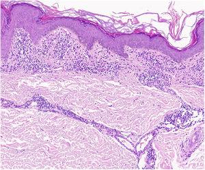 Caractéristiques histopathologiques du lichen aureus. Infiltrat en bande dans le derme papillaire et infiltrat périvasculaire superficiel.