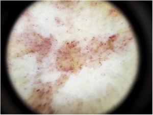 Particules dermoscopiques de la maladie de Schamberg. Fond rouge cuivré et globules rouges.