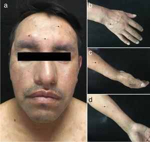 Malignant Syphilis and Pruritic Papular Eruption in an HIV-Positive Man