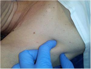Lymph node metastasis in the right armpit.