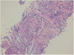 Metastatic adenocarcinoma of the lung. Core-needle biopsy obtained using an 18-G needle (hematoxylin-eosin staining).