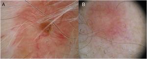 Dermoscopy reveals an orange background without structures and with irregular, centripetally arranged vascularization in 2 lesions (A, B) and an eroded area in 1 lesion (A).