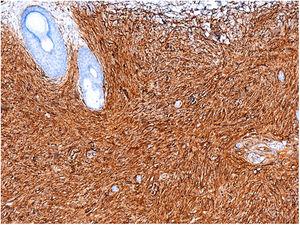 Immunohistochemistry showing positive staining for CD34 (original magnification ×100).