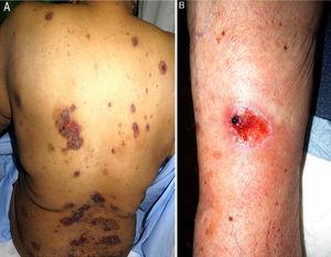 Cutaneous ulcers due to methotrexate. A, Ulcerated psoriasis plaques on the back (patient 3). B, Ulcerated basal cell carcinoma on the leg (patient 5).
