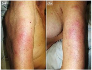 Clinical presentation: Ill-defined, erythematous, infiltrated patches on the extensor surface of the patient’s right (a) and left (b) arms, which were painful upon palpation.
