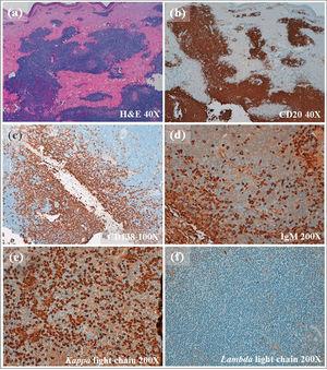 Histopathological findings in skin lesion biopsy: Presence of a diffuse, dense dermal and subcutaneous infiltration (a) by small lymphocytes, lymphoplasmacytoid cells, and plasma cells, staining positive for CD20 (b), CD138 (c) and IgM (d), with kappa light chain restriction (e, f), confirming neoplastic cutaneous involvement by Waldenström’s macroglobulinemia.