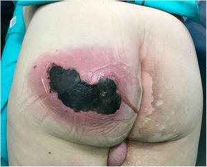 Abscess on the left buttock with active suppuration and a large (10 cm) area of necrosis.