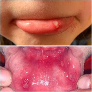 Image of minor ulcers on the lip and mucous membrane of the lower lip.