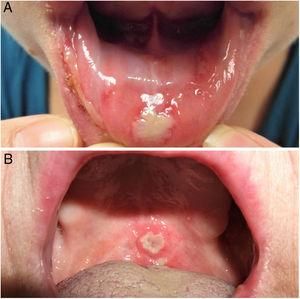 A, Major ulcers on the mucous membrane of the lower lip. B, Ulcer on the soft palate.