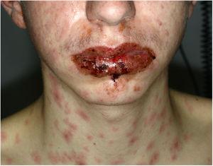 Stevens-Johnson syndrome. Severe mucositis and edema and multiple erosions on the lips.
