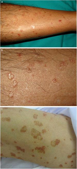 A–B, Disseminated superficial actinic porokeratosis. Multiple well-circumscribed brownish annular plaques with a raised border on the legs. C–, Disseminated superficial porokeratosis. Well-circumscribed brownish plaques with a raised border on the right thigh.