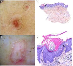 Porokeratosis. A–B, Dermoscopy. Erythematous brownish lesion without clearly defined structures and with a brownish annular border (A). Lesion with structureless white areas and dotted vessels and a hyperkeratotic annular border. Note the double-track sign (B) (Gen Dermlite DL200, ×8). C–D. Histology. Epidermal invagination with a parakeratotic column (cornoid lamella) (arrow)) (hematoxylin–eosin, original magnification ×40) (C). Cornoid lamella (D). Note the loss of the granular layer underlying the parakeratotic column (arrow) and the keratinocytes in the stratum spinosum (hematoxylin–eosin, original magnification ×200). Cornoid lamella (arrow) (hematoxylin–eosin, ×100).