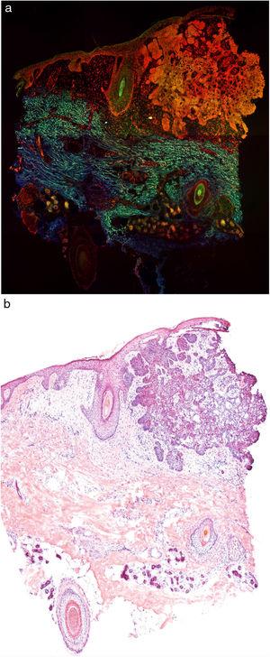 A, Basal cell carcinoma studied with a color fluorescence confocal microscope. B, Note the correlation with traditional hematoxylin-eosin images.