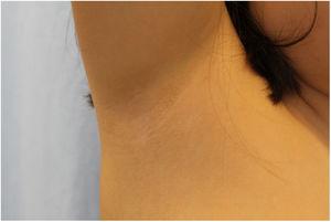 Less severe lesions in the right armpit.