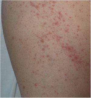Maculopapular rash in a patient with COVID-19 associated with bilateral pneumonia, who received different drugs. Differential diagnosis with respect to toxicoderma is difficult.