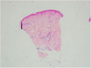 Panoramic image of the biopsy (hematoxylin-eosin staining). The epidermis is preserved. Note the perivascular and periadnexal inflammatory infiltrate in the dermis that extends to the subcutaneous tissue.