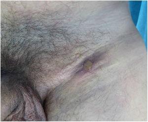 Classic lymphogranuloma venereum. Inguinal buboes suppurating to the skin and a fistulous tract toward the scrotum.