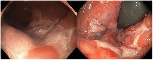 Endoscopy images of an anorectal form of lymphogranuloma. Ulcers with well-defined, irregular, and slightly raised borders with a fibrin-covered base in the distal rectum.