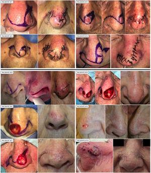 Clinical images that show the design and postoperative outcome of reconstruction by means of crescentic nasojugal flap in 10 patients after excision of carcinomas from the tip of the nose.